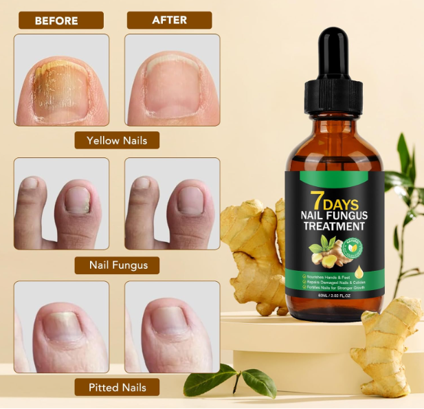 Ginger Nail Repair Essence: Repair Your Nails in 7 Days — Say Goodbye to the Urge to Hide Them
