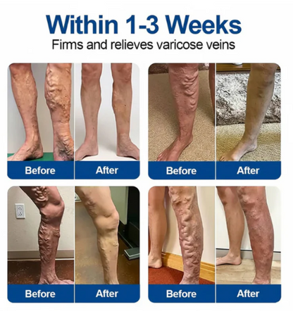 Microneedle Varicose Vein Treatment Patch