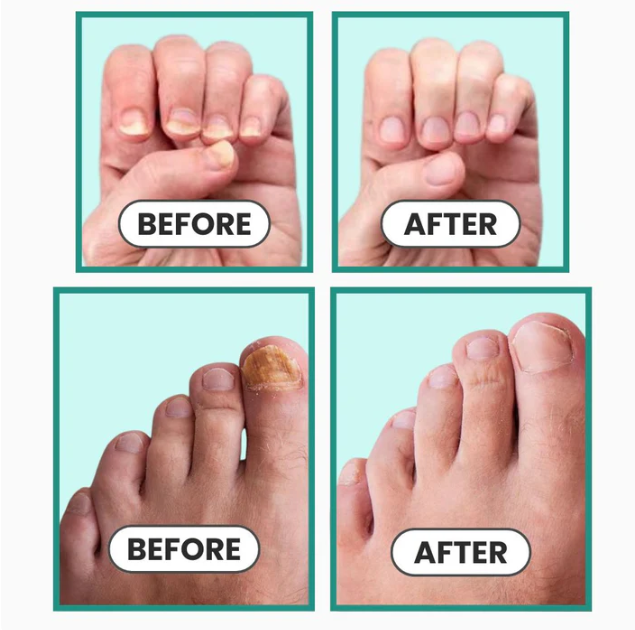 Portable Nail Care Lamp — Treats Nail Fungus at the Source