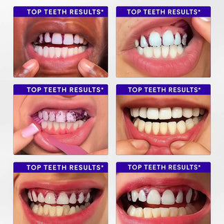 Purple Teeth WhiteningStrips